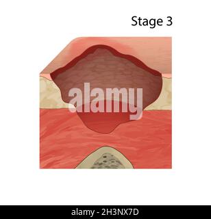 Stage 4 of a Bedsore, Illustration Stock Photo - Alamy