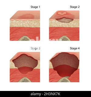 Stages of pressure sores Stock Photo - Alamy