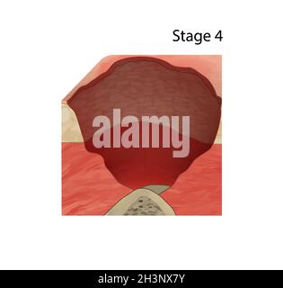 Stage 4 of a Bedsore, Illustration Stock Photo - Alamy