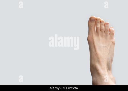 Hallux valgus, bursitis of the foot on a gray background. Fungus of the nails on the disease of the feet. Deformation of the joints of the foot. The p Stock Photo