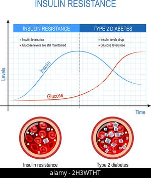 Insulin resistance and Type 2 diabetes. comparison and difference. high blood sugar. Chart with insulin and glucose levels. Cross section of blood Stock Vector