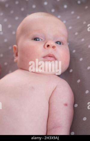 Newborn with traces of BCG vaccination orthe TB vaccine-on his arm. Stock Photo