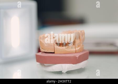 Dental layout of the human jaw with teeth and implants. Stock Photo