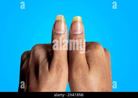 A top view of man's both thumb nails are visible Stock Photo