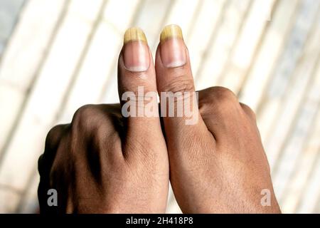 A top view of man's both thumb nails are visible Stock Photo