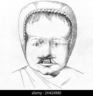 Infant with cleft palate and cleft lip. 19th Century Stock Photo - Alamy