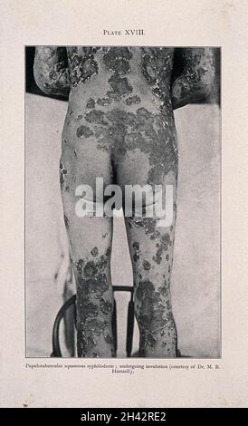 The back, buttocks and legs of a man suffering from syphilis, showing diseased areas of skin affected by papulotubercular squamous syphiloderm. Process print after a photograph, ca. 1905. Stock Photo