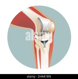Knee Joint Replacement Surgery - Illustration as EPS 10 File Stock Vector