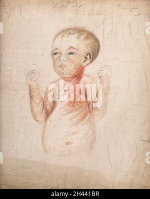 A nine week old baby girl with diseased skin on her face, arms and body, displaying symptoms of hereditary syphilis. Watercolour by C. D'Alton, 1856. Stock Photo