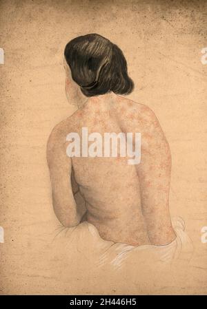 Syphilis Rashes On Back Woman with skin rash caused by syphilis, A. de Montméja, c. 1860 - c ...