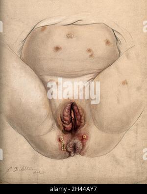 Severely diseased tissue and abcesses around the anus and genital area of a five year old girl suffering from hereditary syphilis, with sores also seen on the thighs and abdomen. Watercolour by C. D'Alton, 1866. Stock Photo