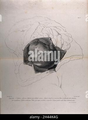 Dissection of the female reproductive organs, showing an ectopic ...