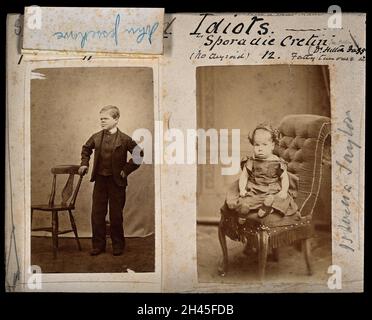 Down's syndrome in a girl and a boy. Two photographs. Stock Photo