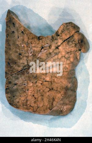 Lung: pneumocystis carinii pneumonia Stock Photo