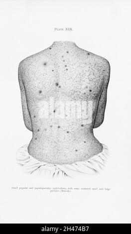The back of a man suffering from syphilis, showing a rash of papular and papulopustular syphiloderm. Colour lithograph after Mracek (?), ca. 1905. Stock Photo