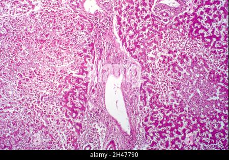 Amoebiasis: amoebic abscess in liver Stock Photo - Alamy