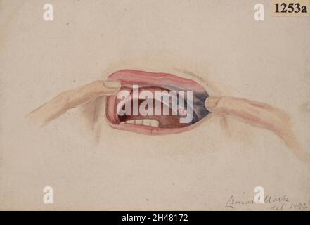 melanotic sarcoma Dermoscopy of venous lake on the lips: A comparative study with labial melanotic  macule main image 1