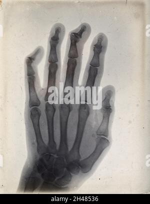 First Radiographers Hand Early medical x ray image of a hand, showing arthritis, 1909. Courtesy ...