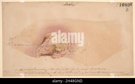 Hospital gangrene affecting the foot, showing near complete detachment of slough Stock Photo