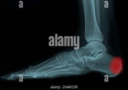 film x-ray foot lateral : show normal child's foot Stock Photo - Alamy