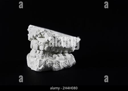 Cast of the jaw made of plaster on black background. Teeth cast for making braces. Dentist and orthodontist work Stock Photo