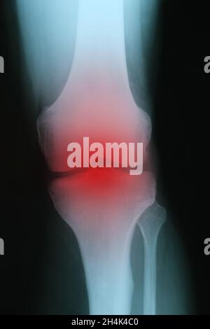 X ray with red inflammation of knee joint closeup Stock Photo