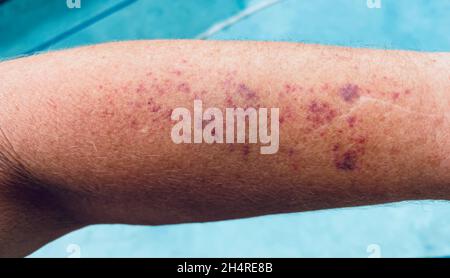 Discolored spots of senile purpura, aging skin Stock Photo