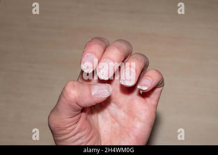 Close-up of flaky bitten and brittle nails without a manicure. Regrown nail cuticle and damaged nail plate after gel polish. Health and beauty problem Stock Photo