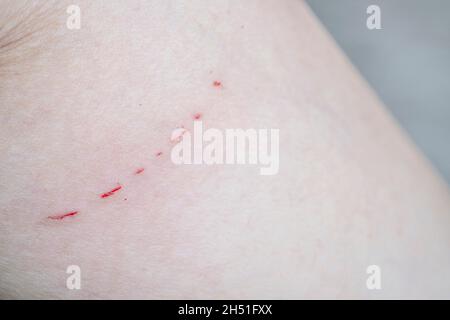 bleeding scar