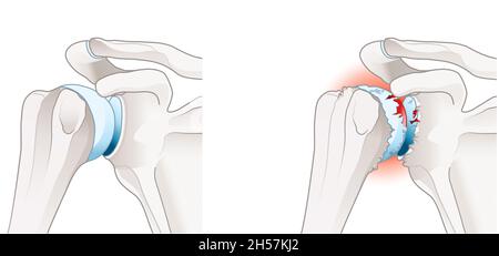 Illustration showing healthy shoulder joint and osteoarthritis of the shoulder joint