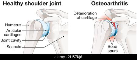 Illustration showing healthy shoulder joint and osteoarthritis of the shoulder joint