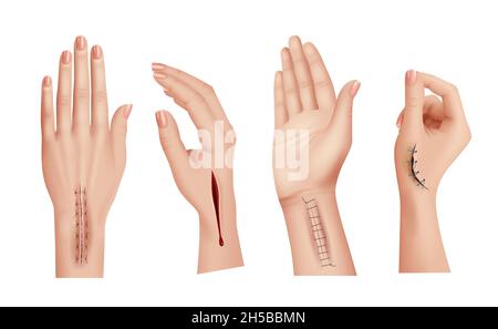 Surgical stitches on hands. Closeup scars and wounds on human hand medical damaged skin decent vector realistic templates Stock Vector