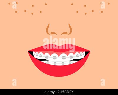 Smile with dental braces. Cartoon medical correct bite of teeth, vector illustration of orthodontic treatment for teeth in mouth by alignment Stock Vector