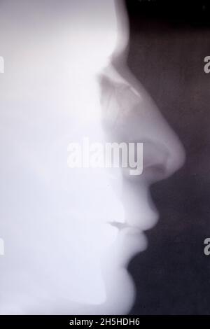 X-ray of a patient with a nose injury Stock Photo