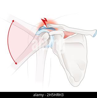 Illustration showing shoulder impingement
