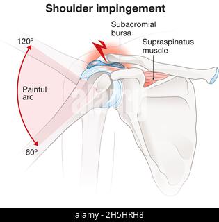 Illustration showing shoulder impingement