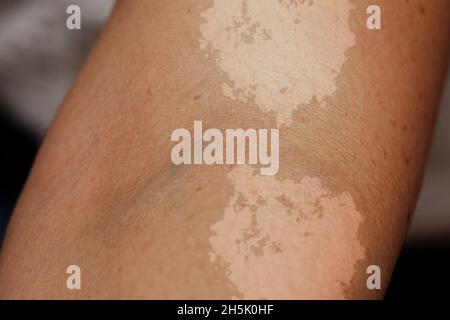 A closeup view on the arm of a person suffering from tinea versicolor Stock Photo