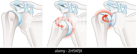Illustration showing painful shoulder dislocation. Labeled