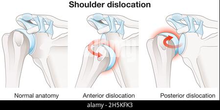 Illustration showing painful shoulder dislocation. Labeled