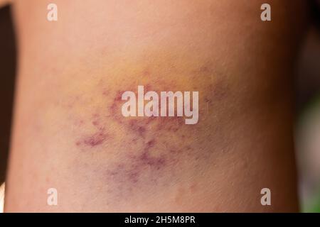 Closeup Bruise on wounded woman's leg skin Stock Photo