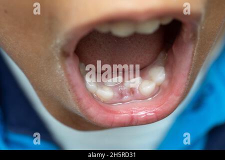 Double row teeh removal on child Stock Photo