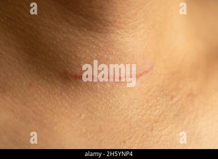 Close up photo of a woman with surgical wound accured due to goiter surgery of thyroid glands. Plastic or cosmetic surgery concept. Stock Photo