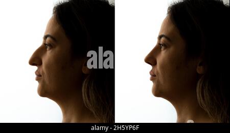 Before and after photo of a woman who had aesthetic nose operation. Aesthetic surgery and beauty concept. Stock Photo