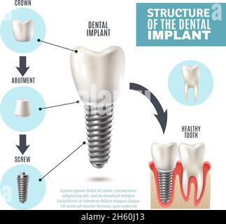 Dental implant structure medical pictorial educative infographic poster with molar replacement end healthy tools models vector illustration Stock Vector