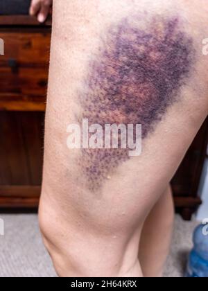 Large coloured bruise damage on upper leg. Hematoma. Stock Photo