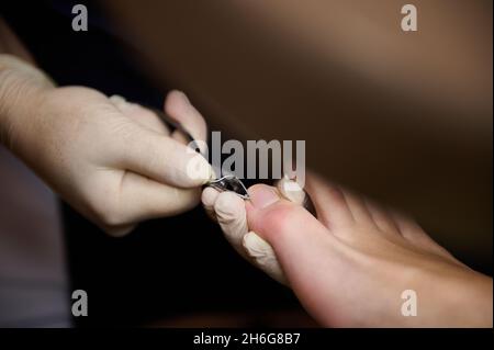 Health, body, nail care and podology treatment concept. Close-up of podiatrist treating toenail fungus. Doctor removes calluses, corns and treats ingr Stock Photo