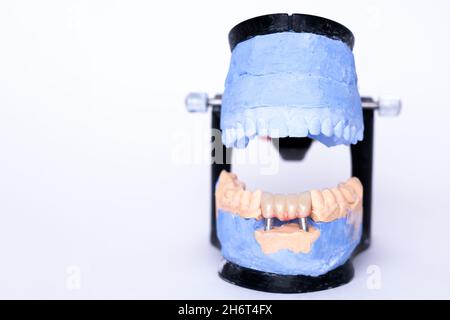 Tooth recovery with implant. Veneers and crowns on gypsum dental artificial jaw on grey background. Plaster model of teeth. White front teeth veneers Stock Photo