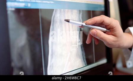 close-up of a doctor's hand pointing to a hand x-ray with a ballpoint pen Stock Photo
