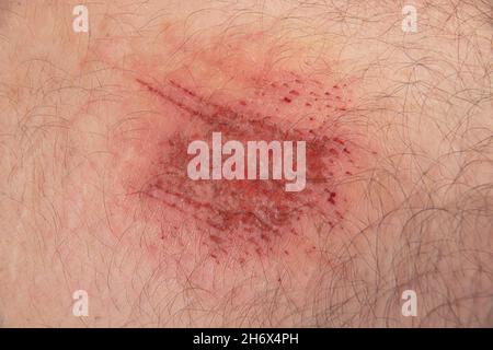 Close up of an abrasion wound in Caucasian skin Stock Photo