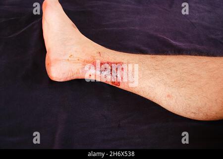 A third-degree burn on the leg of a Caucasian male against black background Stock Photo